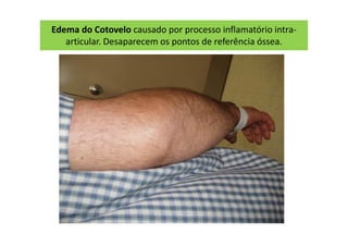 Edema do Cotovelo causado por processo inflamatório intra-
articular. Desaparecem os pontos de referência óssea.
 