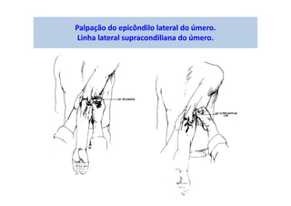 Palpação do epicôndilo lateral do úmero.
Linha lateral supracondiliana do úmero.
 