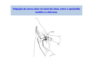 Palpação do nervo ulnar no túnel do ulnar, entre o epicôndilo
medial e o olécrano.
 