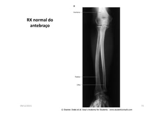 09/12/2015 Dr. José Heitor M. Fernandes 73
RX normal do
antebraço
 