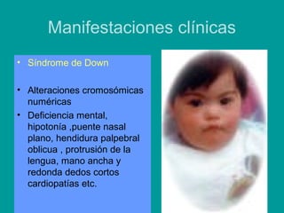 Manifestaciones clínicas 
• Síndrome de Down 
• Alteraciones cromosómicas 
numéricas 
• Deficiencia mental, 
hipotonía ,puente nasal 
plano, hendidura palpebral 
oblicua , protrusión de la 
lengua, mano ancha y 
redonda dedos cortos 
cardiopatías etc. 
 