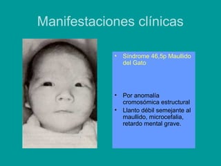 Manifestaciones clínicas 
• Síndrome 46,5p Maullido 
del Gato 
• Por anomalía 
cromosómica estructural 
• Llanto débil semejante al 
maullido, microcefalia, 
retardo mental grave. 
 