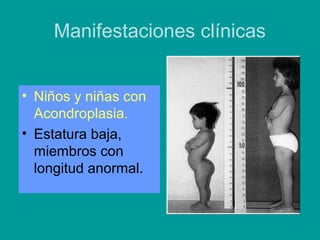 Manifestaciones clínicas 
• Niños y niñas con 
Acondroplasia. 
• Estatura baja, 
miembros con 
longitud anormal. 
 