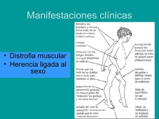 Manifestaciones clínicas 
• Distrofia muscular 
• Herencia ligada al 
sexo 
 