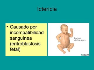 Ictericia 
• Causado por 
incompatibilidad 
sanguínea 
(eritroblastosis 
fetal) 
 
