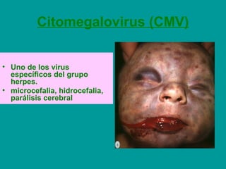Citomegalovirus (CMV) 
• Uno de los virus 
específicos del grupo 
herpes. 
• microcefalia, hidrocefalia, 
parálisis cerebral 
 