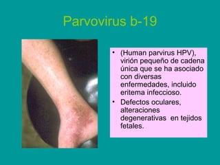 Parvovirus b-19 
• (Human parvirus HPV), 
virión pequeño de cadena 
única que se ha asociado 
con diversas 
enfermedades, incluido 
eritema infeccioso. 
• Defectos oculares, 
alteraciones 
degenerativas en tejidos 
fetales. 
 