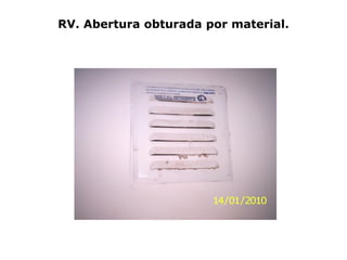 RV. Abertura obturada por material.
 