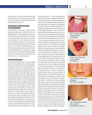TEMA FARMACIA - Gennaio 2017
311MODULO DIDATTICO
streptococciche, la cui virulenza dipende invece dalla
proteina M e la cui sintesi è peculiare di ceppi strep-
tococcici che resistono alla fagocitosi delle cellule da
parte del sistema immunitario.
INCIDENZA,TRASMISSIONE
E INCUBAZIONE
Nel neonato sano e normopeso, la malattia è infre-
quente, grazie agli anticorpi materni acquisiti nel corso
della gravidanza e in parte a quelli assunti durante l’al-
lattamento materno. L’incidenza delle infezioni faringee
e quindi della scarlattina è più frequente nei bambini
di età compresa tra i 5-15 anni. Nelle scuole, nelle ca-
serme, in ambiente domestico e in tutti gli ambienti in
comunità, la trasmissione del batterio risulta altamente
favorita, con una frequenza più elevata durante i mesi
invernali e all’inizio della primavera. Il periodo di incuba-
zione della scarlattina dura in media 3 giorni, cui segue
l’esordio improvviso della malattia; nella sola faringite
streptococcica invece, l’incubazione può essere molto
breve (24 ore) con un massimo di 4 giorni.
SINTOMATOLOGIA
Generalmente nei bambini sotto i 2-3 anni, la malattia
assume sintomatologia blanda con condizioni gene-
rali discrete e febbre non molto elevata. Nei bambini di
età superiore ai 3-4 anni, l’inizio è di regola acuto, con
brividi, febbre, spossatezza, accelerazione del battito
cardiaco, tumefazioni a livello delle stazioni linfonodali
sotto-angolomadibolari e del collo. Rispetto alle altre
malattie esantematiche dell’infanzia, nella scarlattina, di
rilievo è la faringo-tonsillite acuta streptococcica (Figura
6), talvolta molto dolente e che induce disappetenza e
svogliatezza alimentare, accompagnata costantemente
da febbre anche elevata (39-40°C), cefalea e spesso
anche da vomito e addominalgia (a volte così intensa
da far sospettare la condizione di un addome acuto).
Riguardo alla faringo-tonsillite, a fare la differenza ri-
spetto alle comuni altre infezioni virali e a quelle che
si verificano nel corso di altre malattie dell’infanzia, è
l’interessamento della mucosa della lingua che subisce
delle modificazioni caratteristiche. Infatti, durante il 1° e
2° giorno di malattia, la lingua con i bordi già arrossati,
è coperta da una patina bianca sulla quale è possibile
scorgere piccole protuberanze eritematose, espres-
sione dell’ipertrofia di alcune papille (lingua a fragola
bianca) (Figura 7); dal 4° – 5° giorno di malattia, invece
si assiste a una progressiva disepitelizzazione della mu-
cosa linguale che presenta una superficie vellutata per
l’ipertrofia e l’edema della papille (lingua a fragola rossa
o lampone) (Figura 8). La disepitalizzazione della lingua
può essere anche urente e dolente, pregiudicando ul-
teriormente la svogliatezza alimentare già presente per
l’addominalgia e gli episodi di vomito; la mucosa lin-
guale si riepitelizza progressivamente e acquista nuo-
vamente il suo aspetto normale senza alcune reliquato.
Normalmente, la sintomatologia sistemica e il peculiare
interessamento faringo-tonsillare precedono di circa 12
– 48 ore l’insorgenza dell’esantema cutaneo; è carat-
terizzato da piccole e fini papule eritematose in rilievo a
capocchia di spillo (1-2 mm di diametro), granulose alla
palpazione, ravvicinate e che scoloriscono alla digito-
pressione. Compaiono inizialmente a partire dalla radice
degli arti, per generalizzarsi rapidamente in meno di 24
ore. Le lesioni appaiono omogeneamente diffuse sul
corpo con addensamento e accentuazione alle pieghe
cutanee (ascelle, inguine). Poche le parti del corpo in cui
la cute risulta priva di papule (zona peri-orale, mento,
naso), mentre le guance appaiono rosse con tonalità
più intensa rispetto alle altre del corpo (maschera di
Filatov) (Figura 9). Anche i palmi delle mani e la pianta
dei piedi sono privi di papule. In corrispondenza delle
pieghe cutanee delle articolazioni, con prevalenza sul
lato flessorio del gomito, si possono manifestare pe-
tecchie disposte secondo linee trasversali (segno di
Pastia). Strisciando con il dorso dell’unghia sulla cute
eritematosa del piccolo paziente, compaiono strie di
dermografismo bianco (strie di Borsieri) e alla pres-
sione della mano sulla cute, l’eritema scompare per
alcuni istanti e si rende visibile una colorazione gialla
della cute (segno della mano gialla) (Figura 10). Accanto
all’esantema, talvolta possono comparire piccole lesioni
puntiformi a capocchia di spillo (sudamina) soprattutto
sull’addome. La faringite, l’esantema e le altre mani-
festazioni cliniche, febbre inclusa, scompaiono gene-
ralmente al termine della prima settimana di malattia,
anche senza trattamento. Quasi contemporaneamente
inizia la fase di desquamazione: fine al volto e sul corpo,
mentre la desquamazione a larghe foglie compare in
ultimo alle mani e ai piedi (desquamazione a dito di
guanto). La durata e l’intensità della desquamazione
dipendono dall’entità del rush cutaneo e dalla preco-
Figura 10.Segno della mano gialla in
corso di scarlattina
(Fonte Dott.ssa Lucia Restano)
Figura 7.Lingua a“fragola bianca”
in corso di scarlattina
(FonteWikipedia)
Figura 8.Lingua a“fragola rossa”
in corso di scarlattina
(FonteWikipedia)
Figura 9.Maschera di Filatov in corso
di scarlattina
(Fonte Dott.ssa Lucia Restano)
 