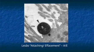 Lesão “Attaching/ Effacement” – A/E
 