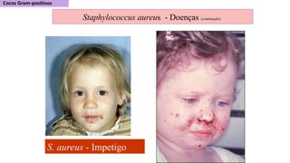 S. aureus - Impetigo
Staphylococcus aureus - Doenças (continuação)
 