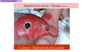 S. aureus - Síndrome da pele escalda
Staphylococcus aureus - Doenças (continuação)
 