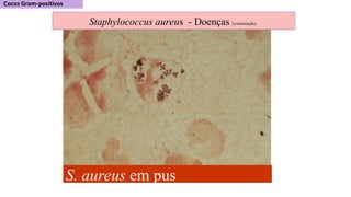 S. aureus em pus
Staphylococcus aureus - Doenças (continuação)
 