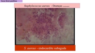S. aureus - endocardite subaguda
Staphylococcus aureus - Doenças (continuação)
 