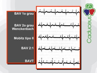 BAV 1o grau
BAV 2o grau
Wenckenbach
Mobitz tipo II
BAV 2:1
BAVT
BAV 1o grau
BAV 2o grau
Wenckenbach
Mobitz tipo II
BAV 2:1
BAVT
 