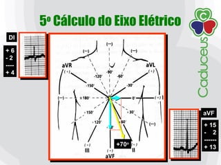 5o
Cálculo do Eixo Elétrico
DI
aVF
+ 6
- 2
----
+ 4
+ 15
- 2
------
+ 13+70o
 