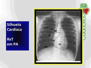 Silhueta
Cardíaca
RxT
em PA
VD
VE
VCI
VCS
Ao
AP
AD
 