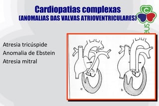 Atresia tricúspide
Anomalia de Ebstein
Atresia mitral
Cardiopatias complexas
(ANOMALIAS DAS VALVAS ATRIOVENTRICULARES)
 
