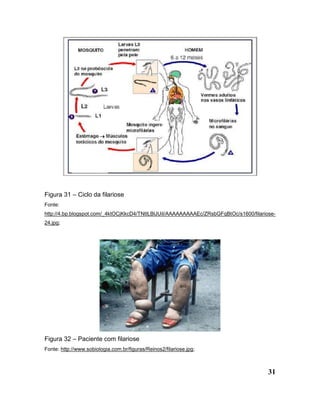 31
Figura 31 – Ciclo da filariose
Fonte:
http://4.bp.blogspot.com/_4ktOCjKkcD4/TNtILBlJUiI/AAAAAAAAAEc/ZRsbGFqBtOc/s1600/filariose-
24.jpg;
Figura 32 – Paciente com filariose
Fonte: http://www.sobiologia.com.br/figuras/Reinos2/filariose.jpg;
 