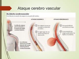 Ataque cerebro vascular
 