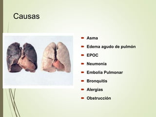 Causas
 Asma
 Edema agudo de pulmón
 EPOC
 Neumonía
 Embolia Pulmonar
 Bronquitis
 Alergias
 Obstrucción
 