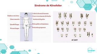 Síndrome de Klinefelter
 
