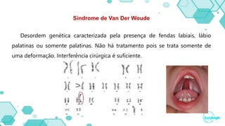 Síndrome de Van Der Woude
Desordem genética caracterizada pela presença de fendas labiais, lábio
palatinas ou somente palatinas. Não há tratamento pois se trata somente de
uma deformação. Interferência cirúrgica é suficiente.
 