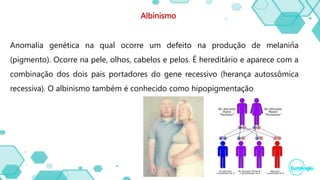 Albinismo
Anomalia genética na qual ocorre um defeito na produção de melanina
(pigmento). Ocorre na pele, olhos, cabelos e pelos. É hereditário e aparece com a
combinação dos dois pais portadores do gene recessivo (herança autossômica
recessiva). O albinismo também é conhecido como hipopigmentação
 