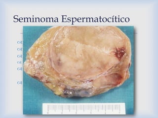 Carcinoma Embrionario
                        
 Forma pura 2-10%
 Componente tumoral 80%
 20-30 años
 Agresivos

MAC...