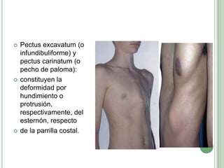 Pectusexcavatum (o infundibuliforme) y pectuscarinatum (o pecho de paloma):constituyen la deformidad por hundimiento o protrusión, respectivamente, del esternón, respectode la parrilla costal.