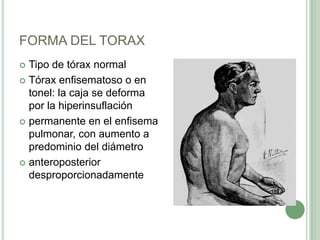 FORMA DEL TORAX
 Tipo de tórax normal
 Tórax enfisematoso o en
  tonel: la caja se deforma
  por la hiperinsuflación
 permanente en el enfisema
  pulmonar, con aumento a
  predominio del diámetro
 anteroposterior
  desproporcionadamente
 