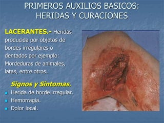 PRIMEROS AUXILIOS BASICOS:
HERIDAS Y CURACIONES
LACERANTES.- Heridas
producida por objetos de
bordes irregulares o
dentados por ejemplo:
Mordeduras de animales,
latas, entre otros.
Signos y Síntomas.
 Herida de borde irregular.
 Hemorragia.
 Dolor local.
 