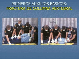 PRIMEROS AUXILIOS BASICOS:
FRACTURA DE COLUMNA VERTEBRAL
 