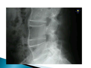 f) Enfermedad de Whipple2. Reactivas