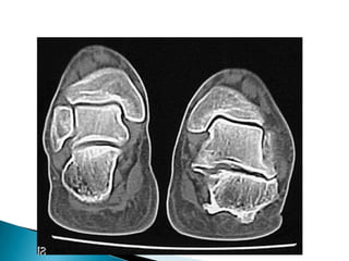 ii) Endocarditis bacteriana subaguda
