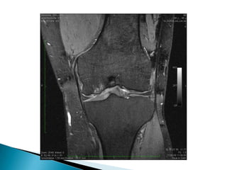 iv) Posdesentérico ( Shigella, yersinia, campylobacter)