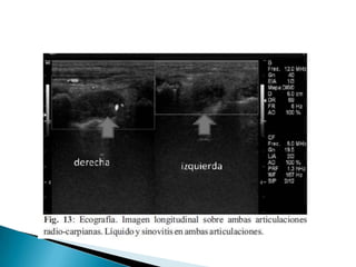 c) Postinmunización