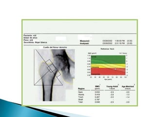 fosforribosiltransferasa ( sindrome de Lesch -