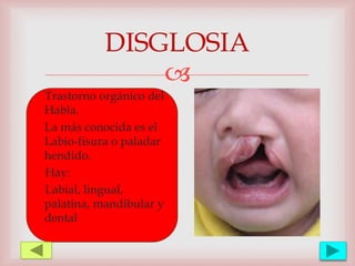 
DISGLOSIA
Trastorno orgánico del
Habla.
La más conocida es el
Labio-fisura o paladar
hendido.
Hay:
Labial, lingual,
palatina, mandibular y
dental
 