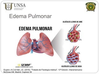 Edema Pulmonar
Guyton, A.C.& Hall, J.E. (2016). "Tratado de Fisiología médica". 13ª Edición. Interamericana-
McGraw-Hill. Madrid. Capitulo 39
 