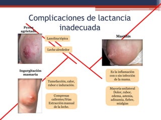 Complicaciones de lactancia
Pezón
agrietado
inadecuada
Lanolina tópica
Leche alrededor
Ingurgitación
mamaria
Tumefacción, calor,
rubor e induración.
Compresas
calientes/frías
Extracción manual
de la leche.
Mastitis
Es la inflamación
con o sin infección
de la mama.
Mayoría unilateral
Dolor, rubor,
edema, astenia,
adinamia, fiebre,
mialgias
 