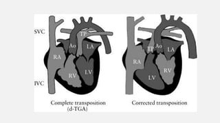 Modul TGA Transposition of Great Arteries.pptx