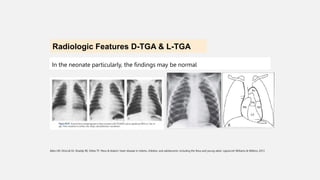 Tga Loop Types Modul TGA Transposition of Great Arteries.pptx