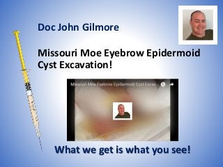 Missouri Moe Eyebrow Epidermoid
Cyst Excavation!
What we get is what you see!
Doc John Gilmore
 