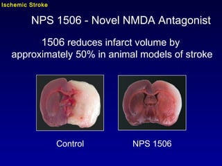 1506 reduces infarct volume by
approximately 50% in animal models of stroke
NPS 1506 - Novel NMDA Antagonist
Control NPS 1506
Ischemic Stroke
 