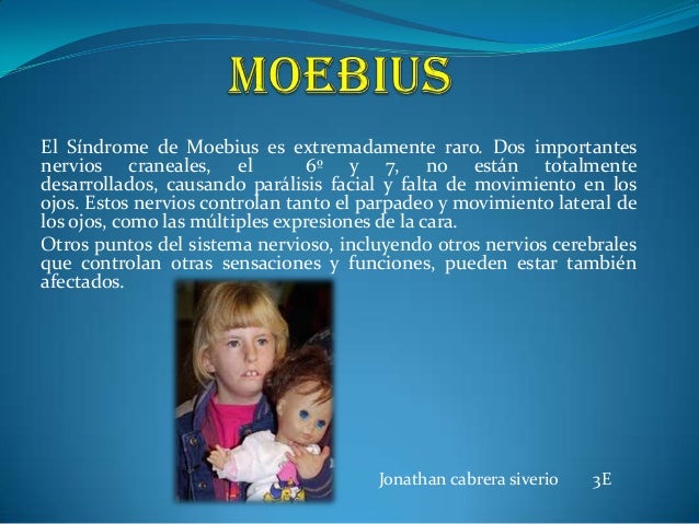 Simbolo Del Sindrome De Moebius