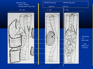 Ngoài ống sống TRONG Ống sống TRONG Ống sống
. xương , đĩa đệm ,
. Khoang quanh màng cứng ngoài tuỷ trong tuỷ
90 / 100 2 / 100 8 / 100
tổn thương
tuỷ
‘’ phãu thuật ‘’
hoặc
Bệnh lý tuỷ
nội khoa
 