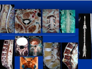 Moelle    poly 5 p(fil eminimizer)