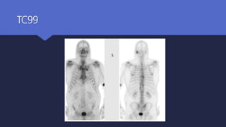 TC99
 