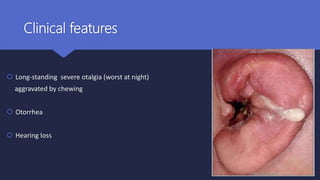 Clinical features
 Long-standing severe otalgia (worst at night)
aggravated by chewing
 Otorrhea
 Hearing loss
 